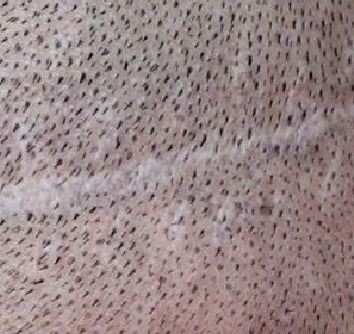 dermopigmentation