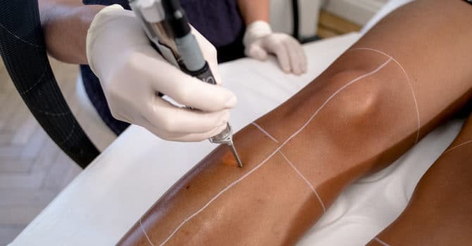 epilation laser