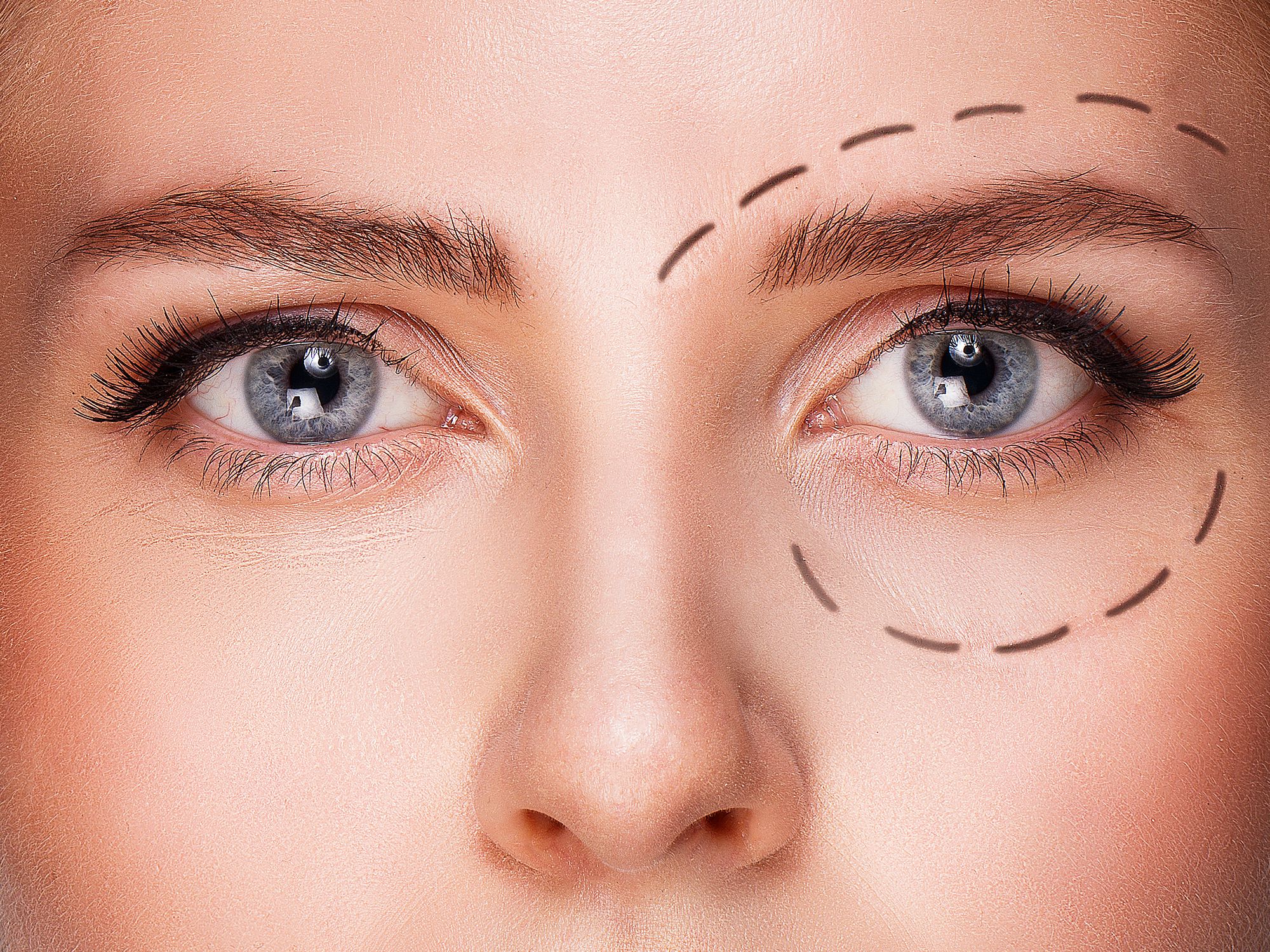 blepharoplastie-chirurgie-paupieres