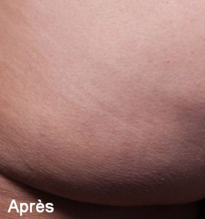 cellulite après