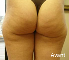 cellulite avant