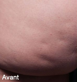 cellulite avant