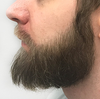 greffe barbe
