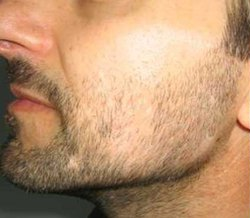 greffe barbe avant