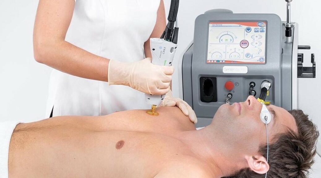 epilation hommes