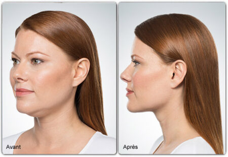 kybella2-avap