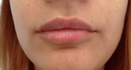 lèvres injection acide hyaluronique avant après