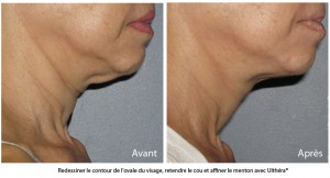 lifting-ovale-visage-centre-ultherapy-paris3-300x162