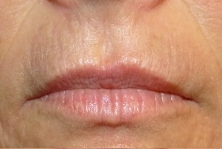 microneedling