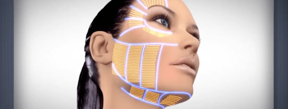 ultherapy