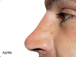 rhinoplastie médicale avant