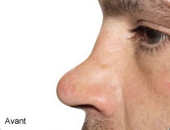 rhinoplastie médicale avant