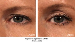 ultherapy paupières femme trois quart avant après - CSHP Paris