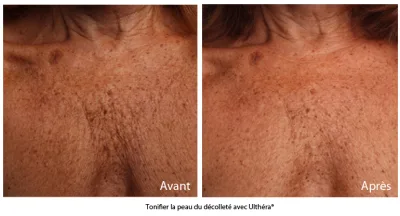 ultherapy décolleté femme rousse avant après - CSHP Paris