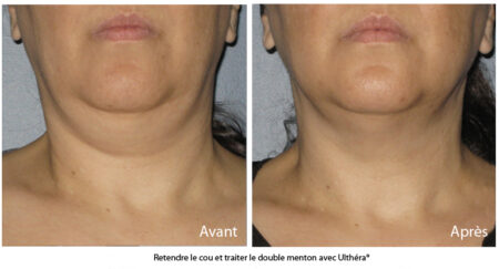 hifu visage menton femme avant après - CSHP Paris