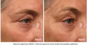 ultherapy paupières femme trois quart avant après - CSHP Paris