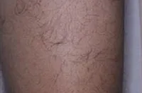 epilation jambes