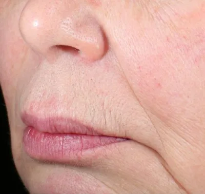 epilation visage