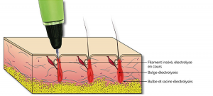 épilation électrique schéma