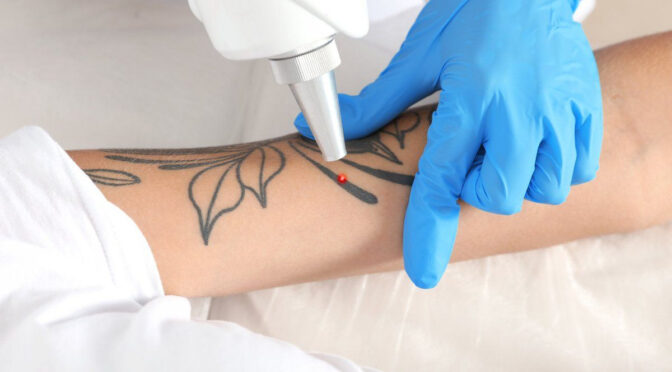 Image : Enlever définitivement un tatouage ? C’est possible !