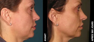Ulthérapy PRIME : Le lifting du visage HIFU sans chirurgie