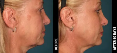Ulthérapy PRIME : Le lifting du visage HIFU sans chirurgie