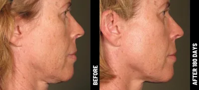 Ulthérapy PRIME : Le lifting du visage HIFU sans chirurgie