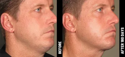 Ulthérapy PRIME : Le lifting du visage HIFU sans chirurgie