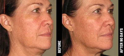 Ulthérapy PRIME : Le lifting du visage HIFU sans chirurgie